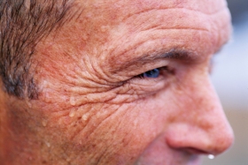 wrinkles